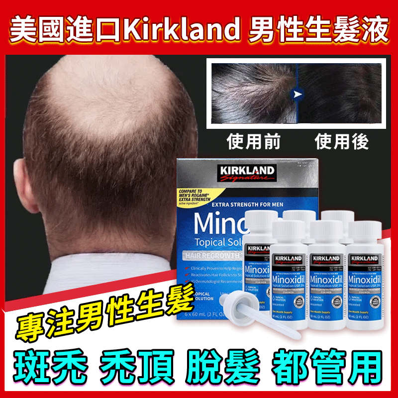 美國原裝進口科克蘭男性生髮液，全球皮膚科醫師首推生髮成分，5%米諾地爾頭皮溶液，全球市場唯一認證的最高含量產品！激活萎縮毛囊，從根源上强根健髮！