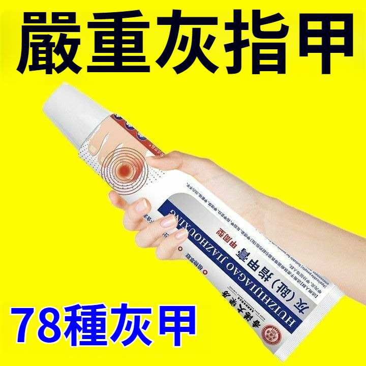 【30年灰甲1次性去根，100位權威專家聯合推薦，媒體爭相報道，無激素，無副作用，無依賴性，防止復發】臭甲反反復復不見好轉？灰指甲引發甲溝炎，影響走路？香港藥局，灰指甲藥膏，專攻頑固性灰指甲，治甲癬，指甲真菌感染，髮黃，變厚，壞甲
